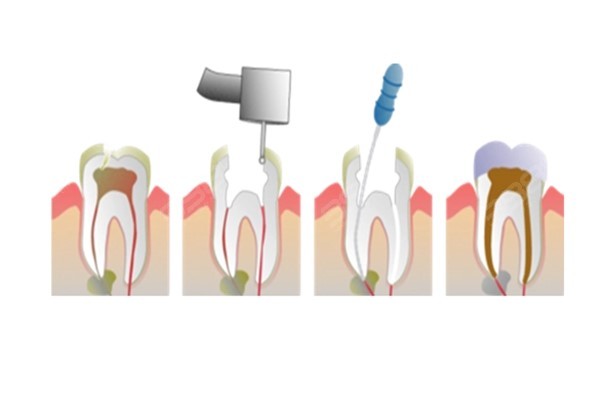 牙髓是活的可以不用做根管治疗吗？