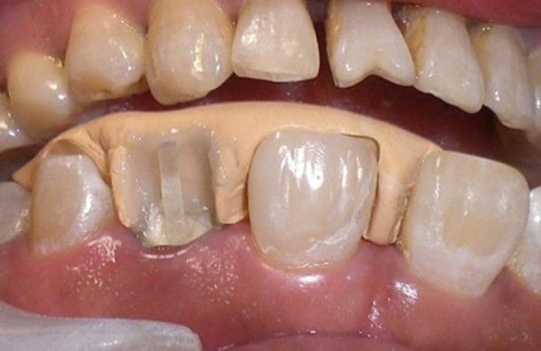 牙齿断一半的是用树脂还是牙冠修复?门牙美学补牙这样做很实惠