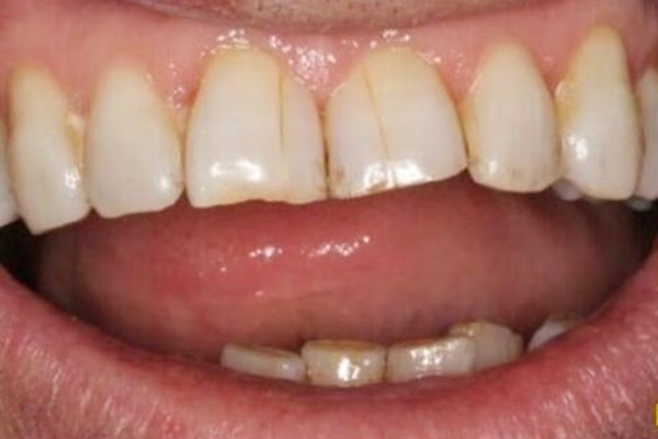 牙齿表面裂纹图片大全,解读透光看牙齿表面有裂纹是怎么回事