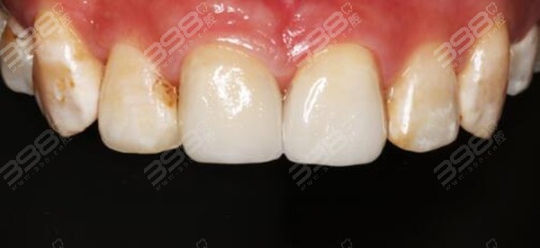 牙齿断一半的是用树脂还是牙冠修复