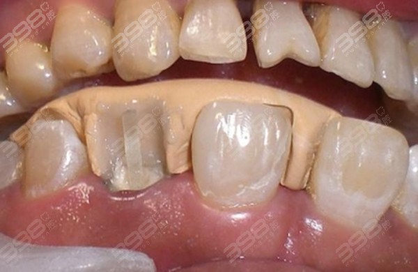 牙齿断一半的是用树脂还是牙冠修复?门牙美学补牙这样做很实惠
