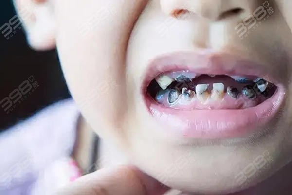 经常喝鲜榨果汁 以为是健康结果孩子牙齿全部坏掉！