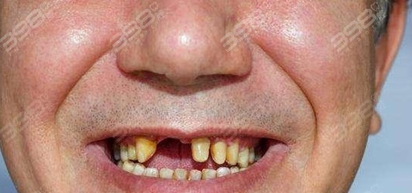 40多岁掉牙齿是不是寿命不长