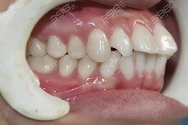 牙齿外突的矫正