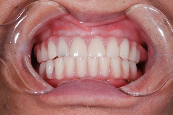 种植全口牙一般要多久才能完成?即刻负重种植牙4-6个月左右搞定