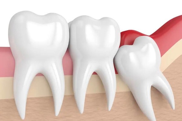 当智齿遇上牙髓炎，直接拔除好还是开髓后拔除？听听牙医怎么说