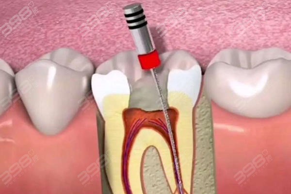 牙齿根管治疗
