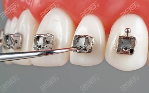 为什么矫正牙齿更容易得蛀牙？正畸的时候出现蛀牙怎么办？