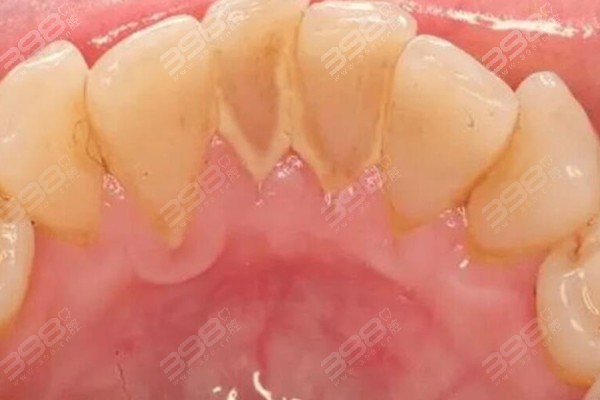 牙缝中抠出的黄泥是什么东西？为什么会臭臭的？真相在此