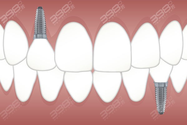 种植牙 (2).jpg