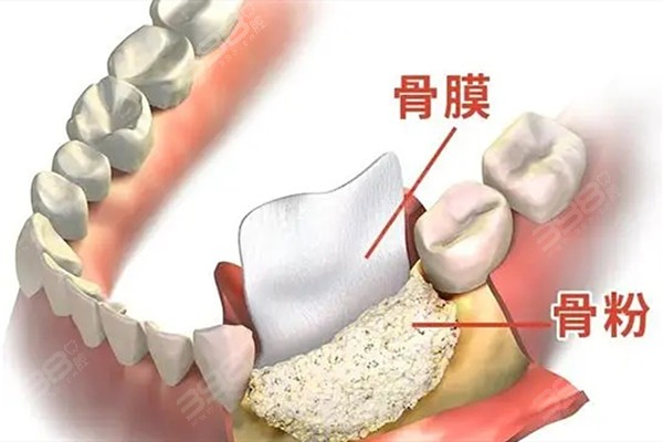 种植牙骨增量手术