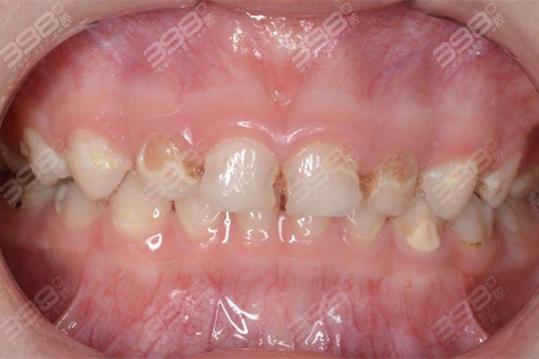 宝宝乳牙根管治疗后，会影响恒牙的正常生长吗？