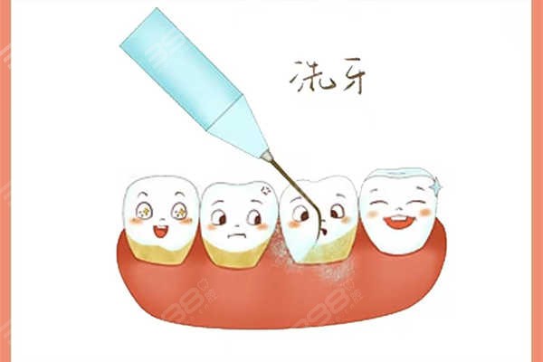 滁州苏陵牙贝佳口腔拔牙、洗牙、根管治疗、镶牙费用