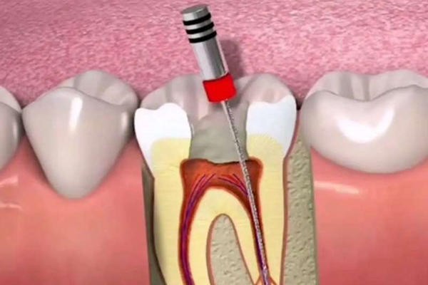 海口根管治疗多少钱一颗牙，再了解下海口牙科哪家好