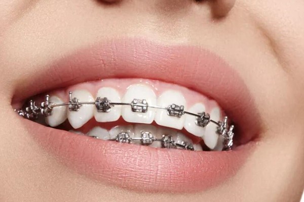 关于牙齿矫正的“十万个为什么”，为你系统解答！