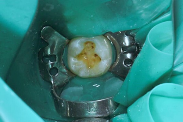补牙材料掉了怎么办?如果我的补牙材料脱落可以直接补吗?
