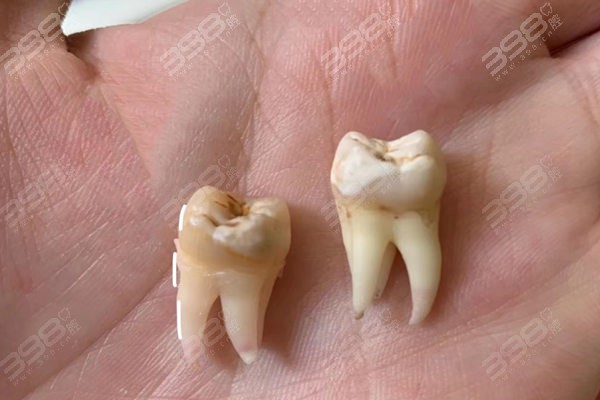 哪颗牙叫智齿牙图片图片