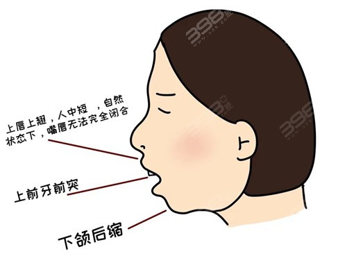 口呼吸导致面部畸形发育