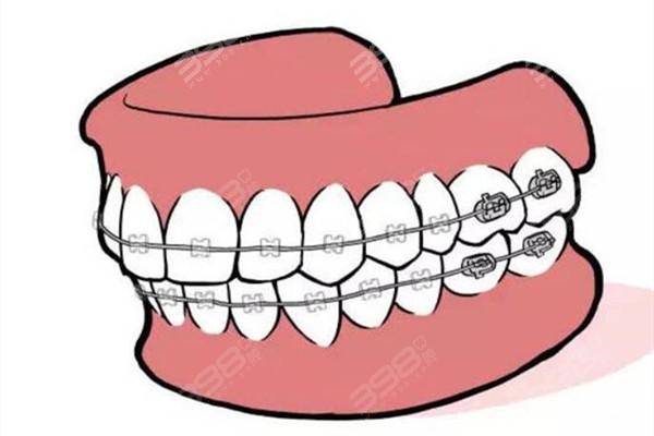 太原牙齿矫正医院哪个好？小苹果/众植/美齿口腔整牙技术好