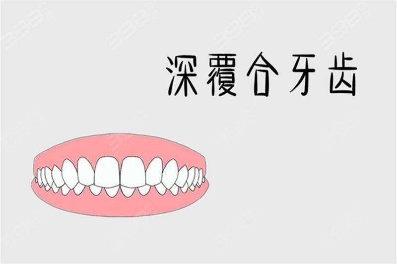 牙齿深覆合有必要矫正吗？为什么有人说深覆合不建议整牙？