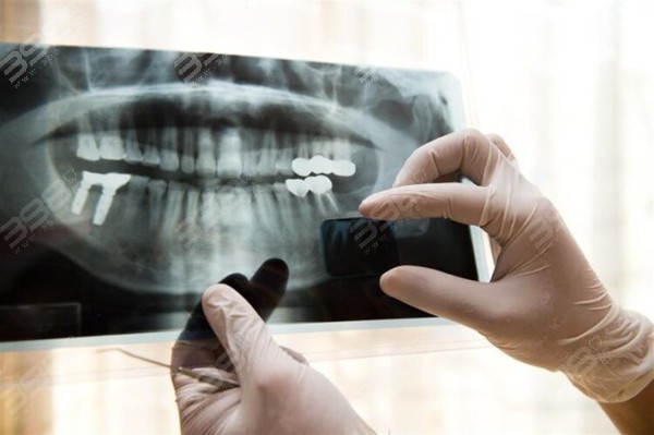 分析种植牙图解全过程 含种植牙手术视频及半口/全口种植方式