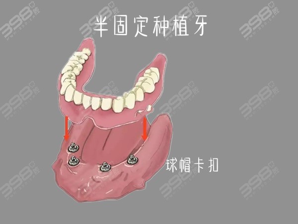 广州全口半固定种植牙