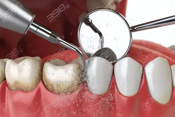 合肥洗牙多少钱一次？找到了合肥洁牙价格不贵还正规的牙科医院