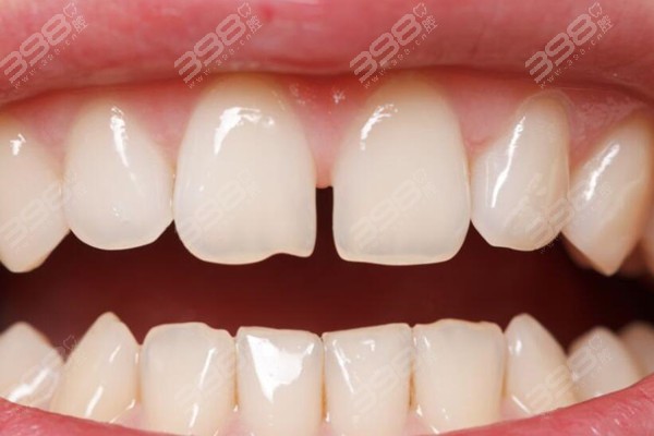 42岁牙缝大怎么修复？参考这几种方法让牙缝收收收!