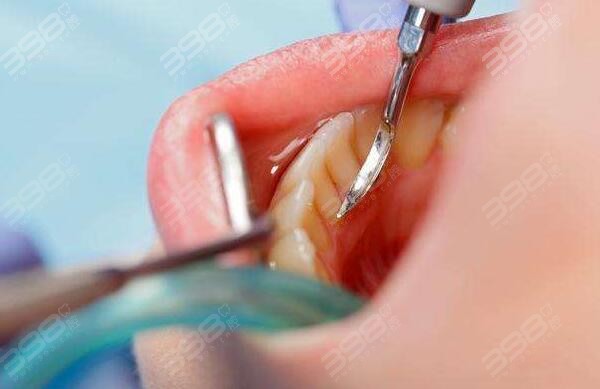 乳牙蛀牙也有导致颅内感染/败血症等风险