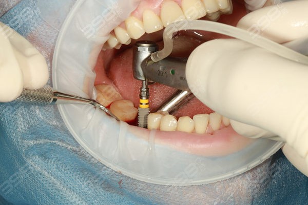 哪种人不适合种牙？这5种不宜种植牙的人可以考虑活动假牙