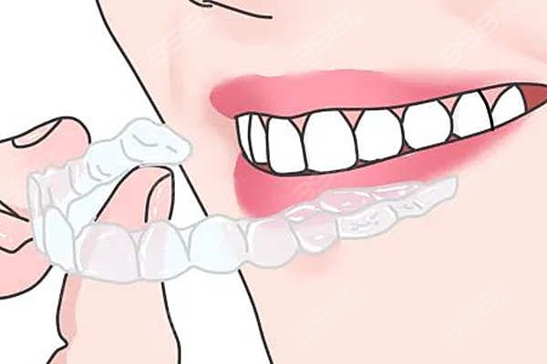 隐形矫正重启是什么意思？为什么隐形牙套会重启？
