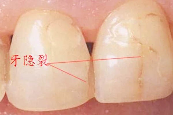 惊!牙齿上的黑线是蛀牙吗?请问牙齿上的黑线刷不掉该怎么去除?