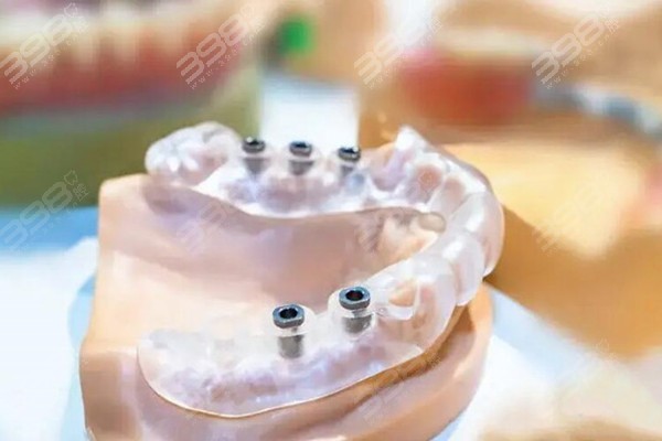 半口半固定种植牙流程