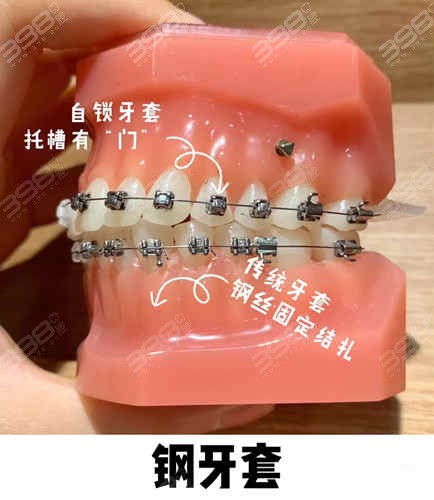 上海普陀区牙齿矫正多少钱？
