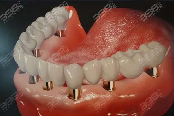 种植牙后期会出现很多问题吗？