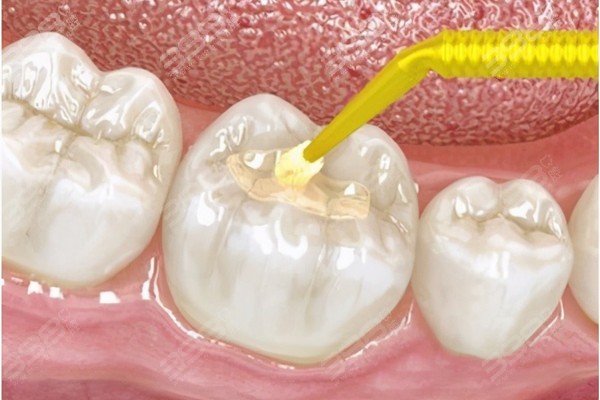 桂林补牙可以用医保吗?帮你推荐桂林补牙价格便宜且能刷社保的牙科