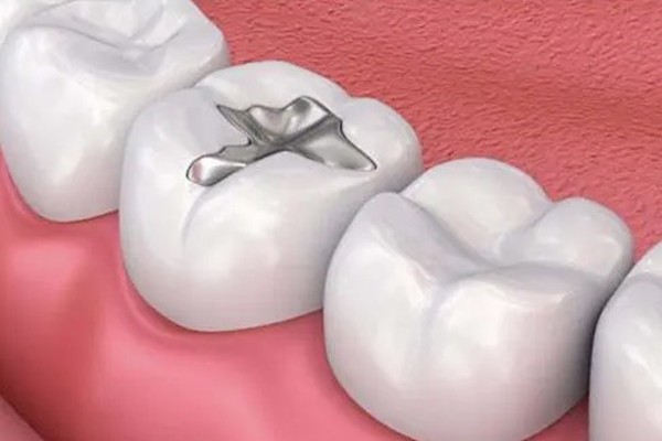 牙冠和嵌体哪个实用性强？牙冠和嵌体价格、实用性综合pk