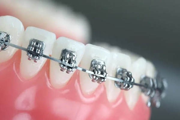 成都双流牙齿矫正医院推荐，金属/隐形牙套可选这三家