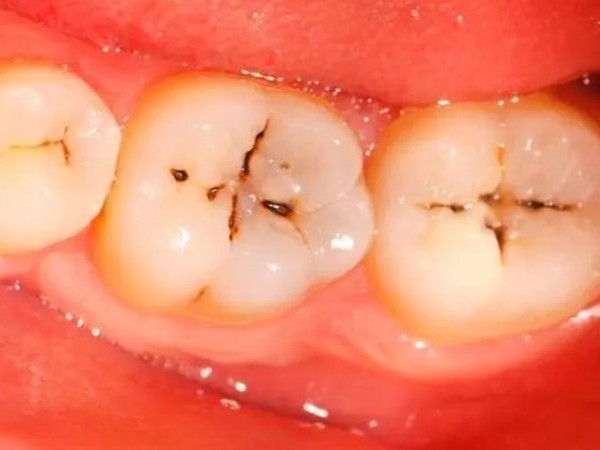 孩子八岁牙齿有洞要补吗?为什么有人说8岁蛀牙洞千万不能补?