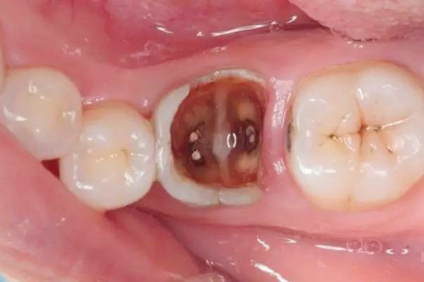 深龋千万别补牙去做根管治疗,能多维持几年,否则小心牙齿劈裂报废