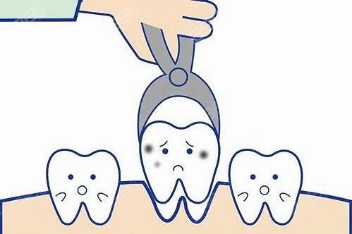 牙齿矫正和拔牙有什么关系