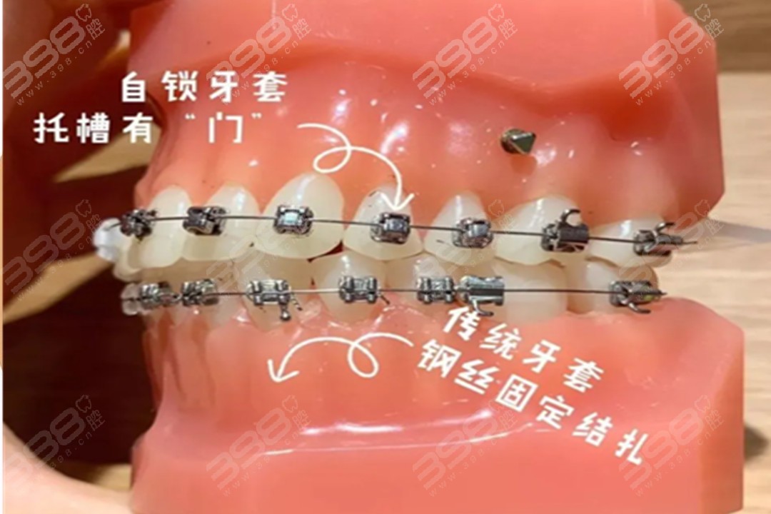 金属自锁牙套矫正原理是什么？传统金属牙套和金属自锁你分得清吗