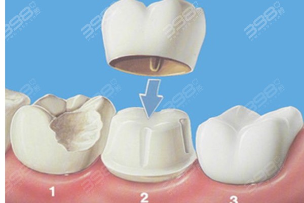 牙冠和嵌体哪个寿命长？了解这些后你就会知道选牙冠还是嵌体