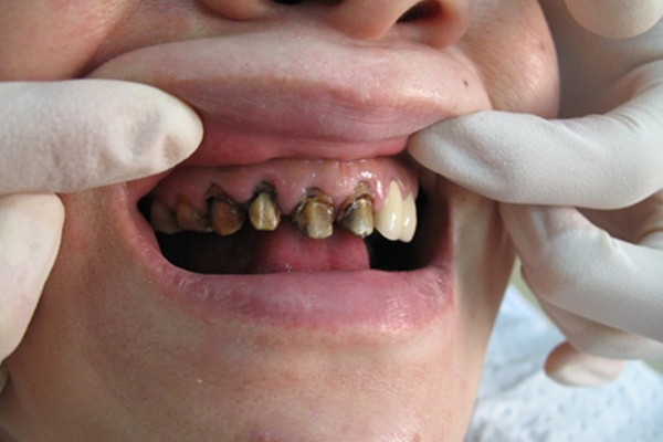 烤瓷牙10年后的图片,良心建议使用十年的烤瓷牙牙龈发黑一定及时更换