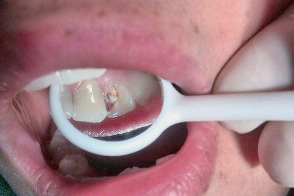 为什么小诊所补牙便宜?揭秘小诊所补牙/全瓷牙/根管治疗低价秘密