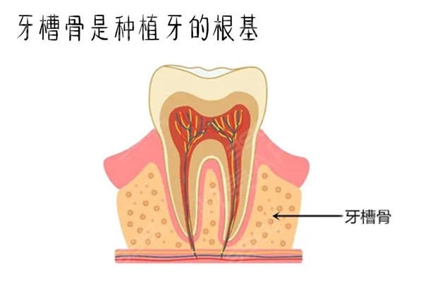 牙槽骨和种植牙