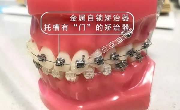 医生推荐钢丝不推荐隐形牙套?想知道隐形牙套和钢牙套哪个效果好?