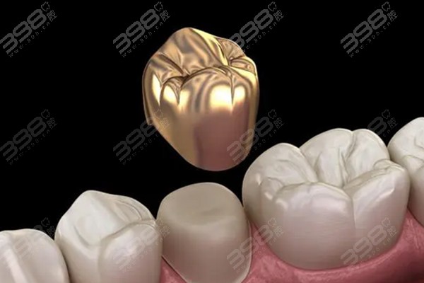 牙冠分为哪些种类