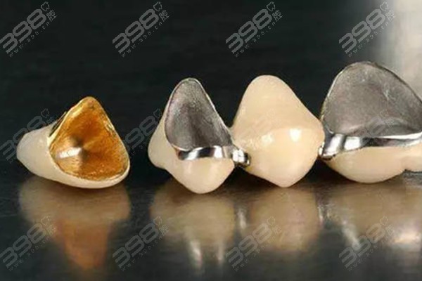 牙冠材料哪种好？金属冠/金属烤瓷冠/全瓷冠的利弊分别是什么？