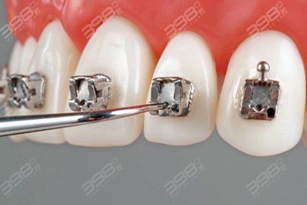 一个牙医的良心正畸忠告：牙齿矫正这些坑千万要避开
